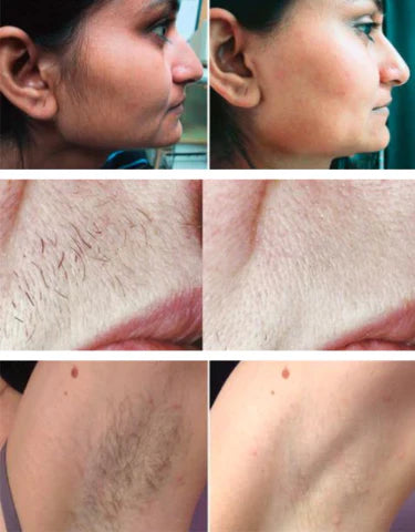 depilador, facial, portátil, sem dor, depilação indolor, pele lisa, beleza, remoção de pelos, bivolt, carregamento USB, compacto, hipoalergênico, rosto, corpo, depilador feminino, prática, discreta, depilador elétrico, depilação rápida, depilação segura, depilação portátil, depilador portátil, caneta depiladora, depilação sem dor, pele sensível, depilador bivolt, beleza feminina, higiene pessoal, depilação facial, depilação corporal, produto original, seguro, discreto, leve, eficiente